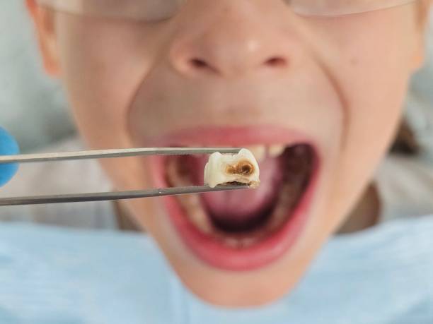 Best Emergency Dentist for Knocked-Out Tooth in Bassett, VA